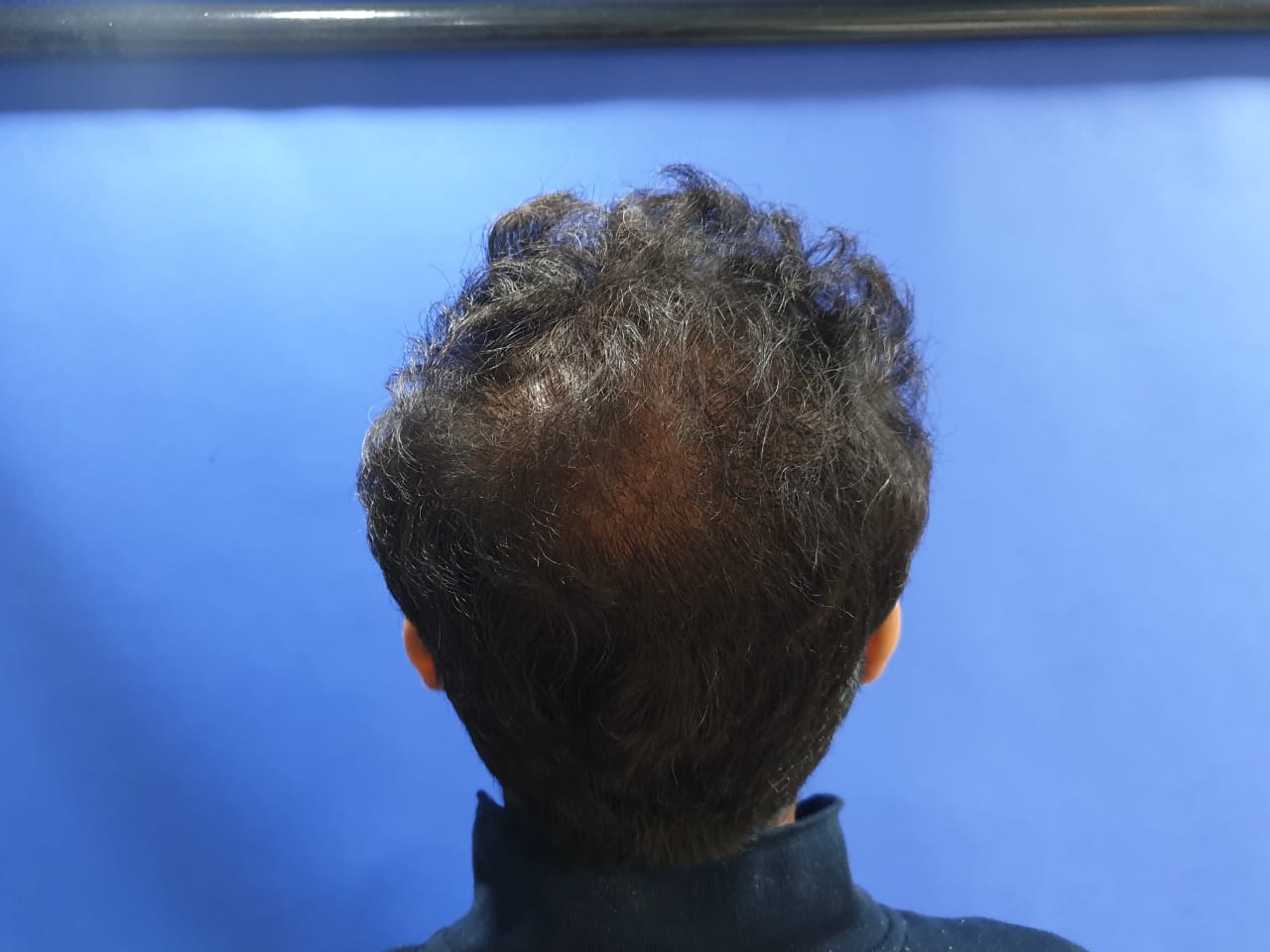 hair transplant 103