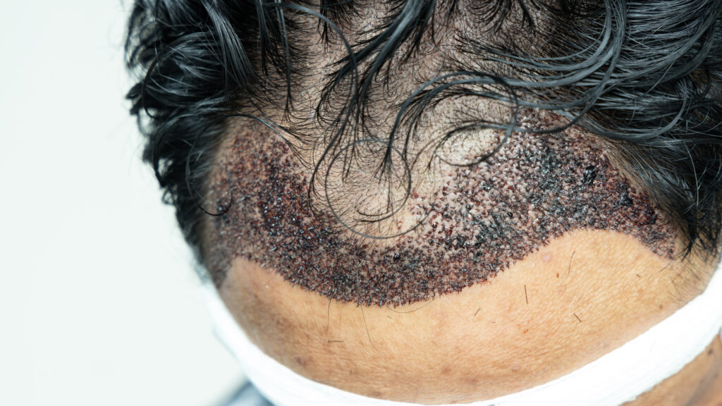 FUE hair transplant