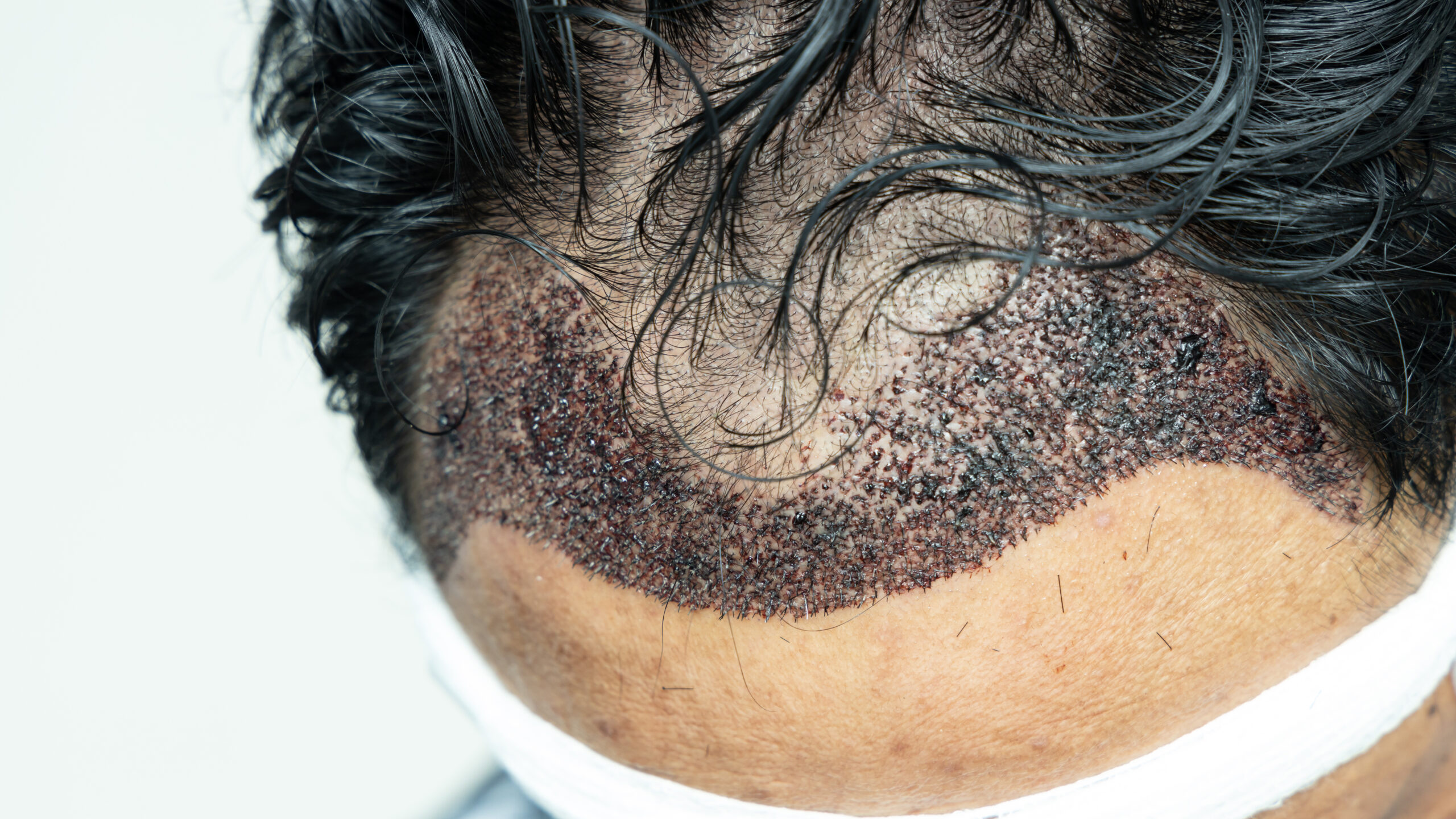 Man head with hair transplant surgery with receding hair line, FUE, Follicular unit extraction, Types of hair transplant procedures and their stages. Male alopecia treatment.