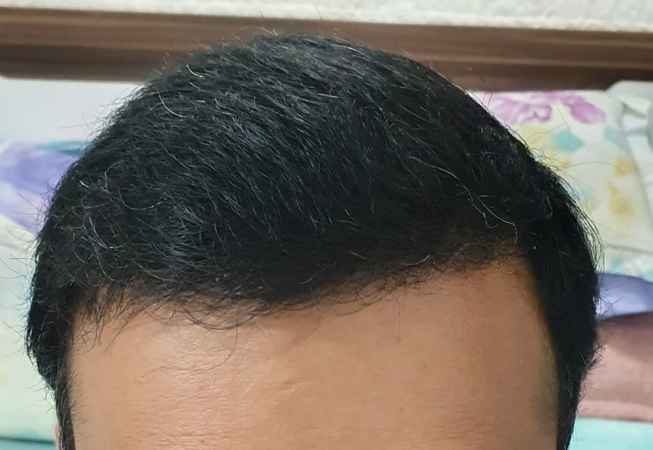 hair transplant 101