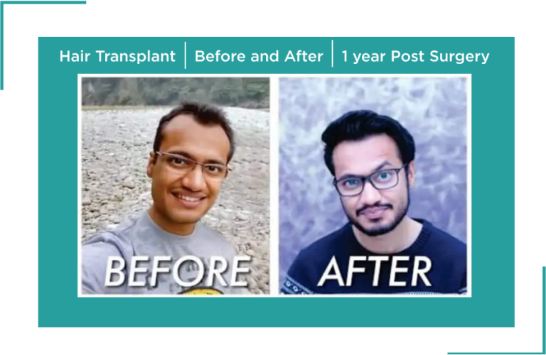 hair transplant surgery