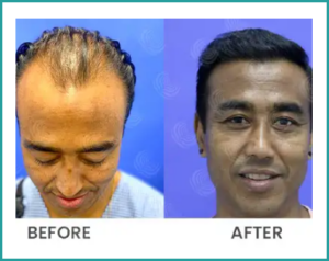 hair implant before and after