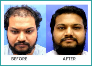 Hair transplant results