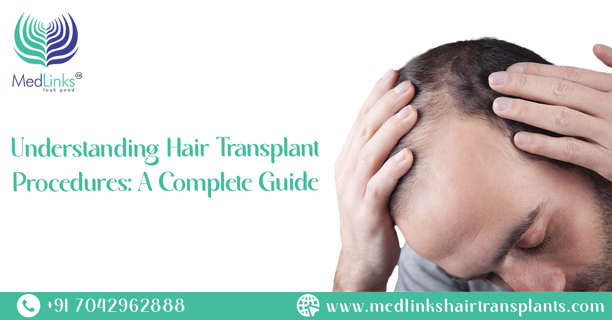Understanding Hair Transplant Procedures: A Complete Guide