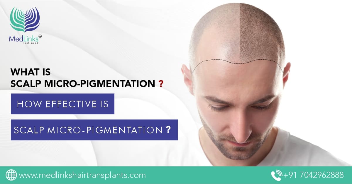 What is Scalp Micro Pigmentation? | How Effective Is SMP?