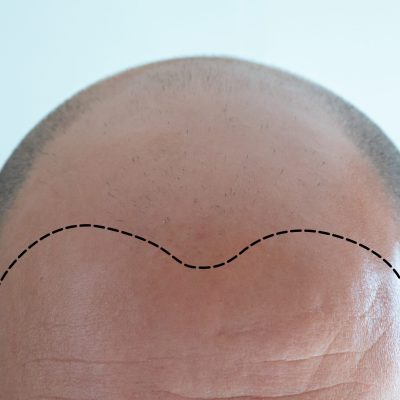 Robotic Hair Transplant